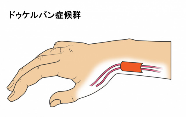 腱鞘炎(ド・ゲルバン)